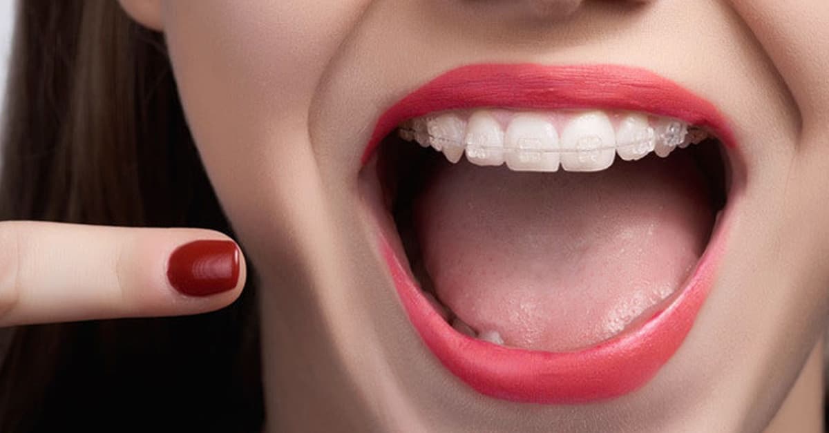 Limpieza dental y férula de descarga blanda o impresa Michigan