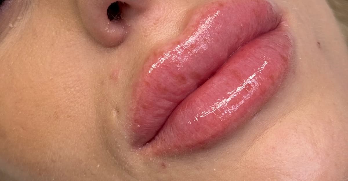 Tratamiento con microagujas