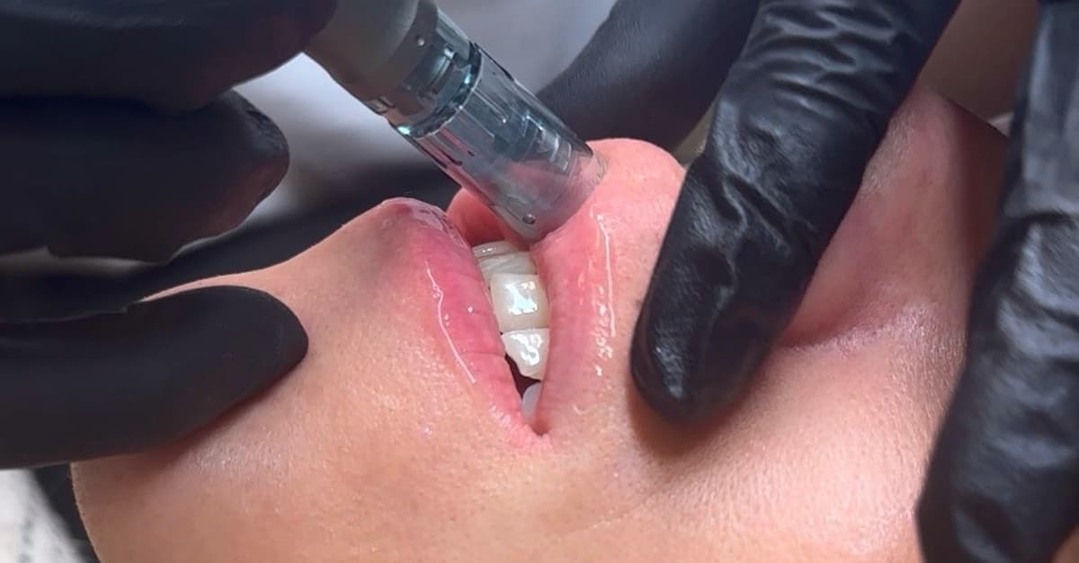 Sesión de rehidratación de labios con dermapen y vitaminas para 1